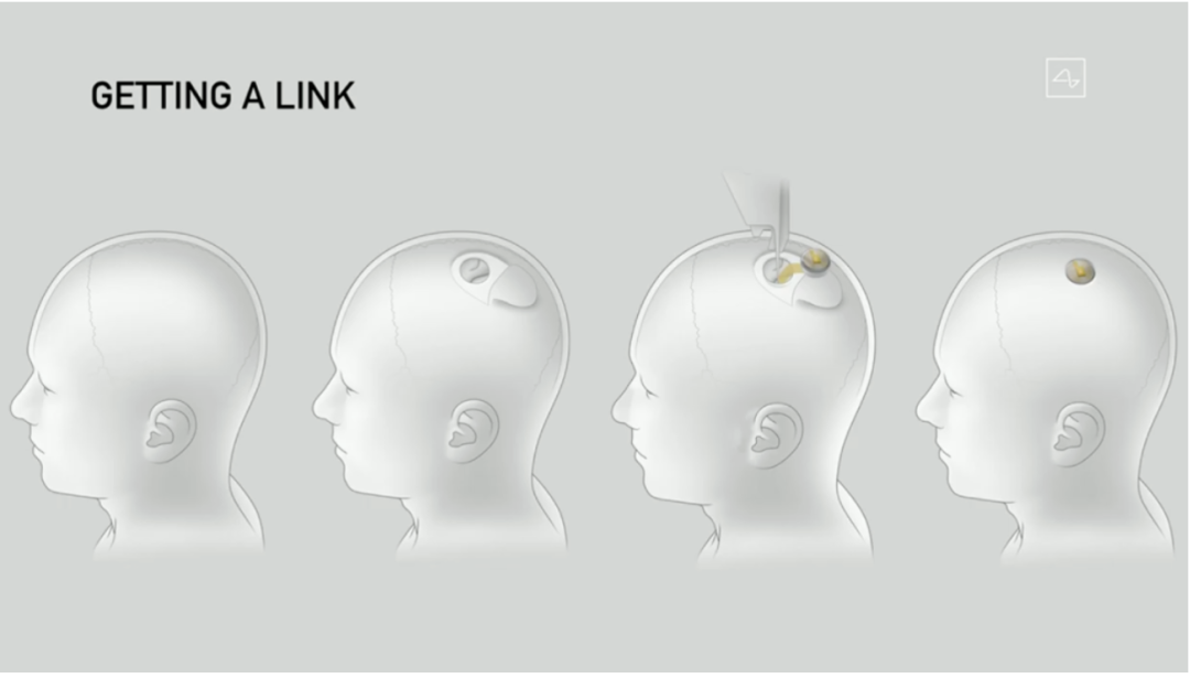 马斯克的脑机生意：找找亮点，再泼一盆冷水