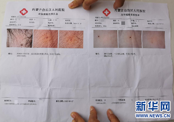 呼和浩特一幼儿园多名孩子身上有不明针眼，警方介入调查