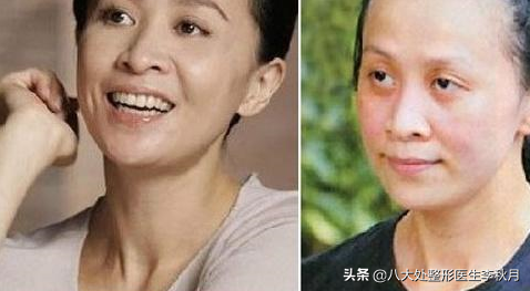 娱乐圈明星都被眼皮松弛问题所困扰，我们常人亦是如此，怎么破？