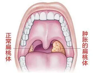 咽口水都痛，晚上睡不好…咽喉痛，不容忽视