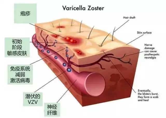 腰缠火龙是什么（腰缠火龙的症状和注意事项）