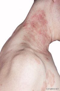 肛门湿疹症状有哪些_肛门湿疹的症状和注意事项