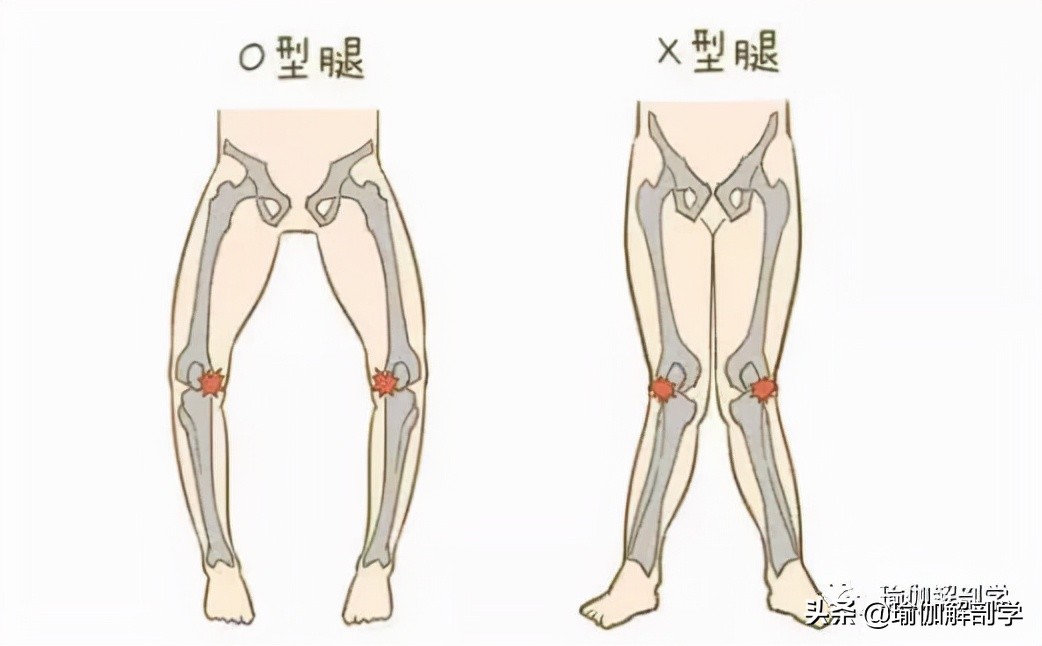 罗圈腿怎么办_罗圈腿的矫正方法