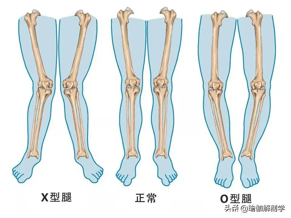 罗圈腿怎么办_罗圈腿的矫正方法