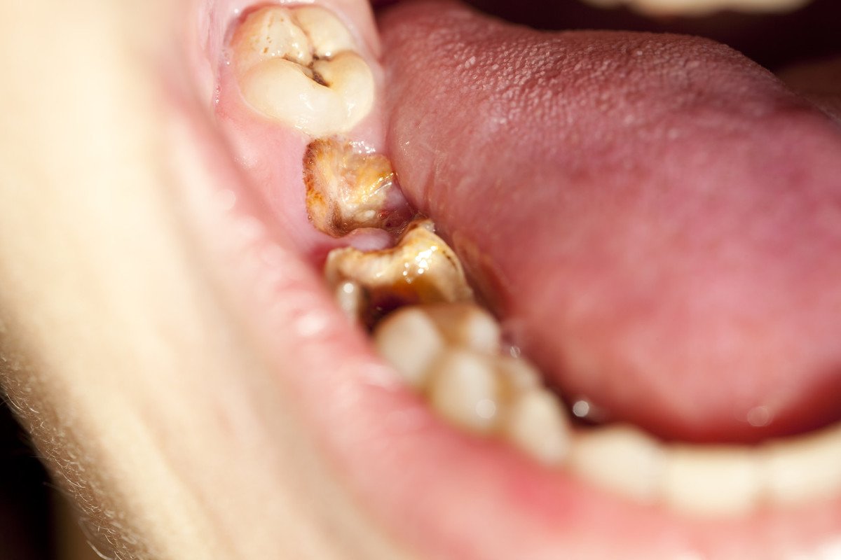 牙齿的根管怎么治疗_牙齿的根管治疗方法