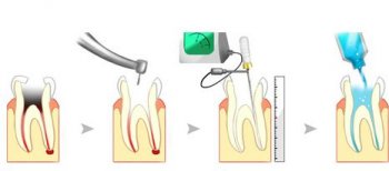 牙齿的根管怎么治疗_牙齿的根管治疗方法