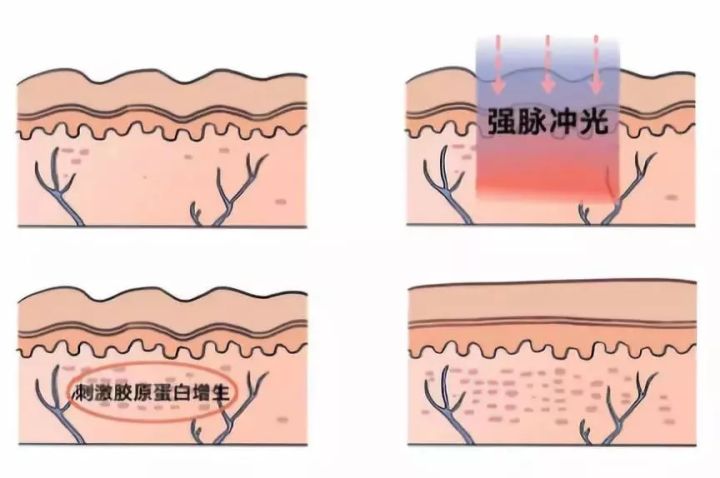 怎样修复痘坑_修复痘坑的小技巧