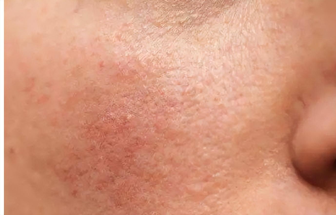 秋冬季皮肤又油又干怎么护肤？