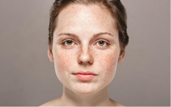 如何消除色斑不反复，女人淡化色斑小妙招