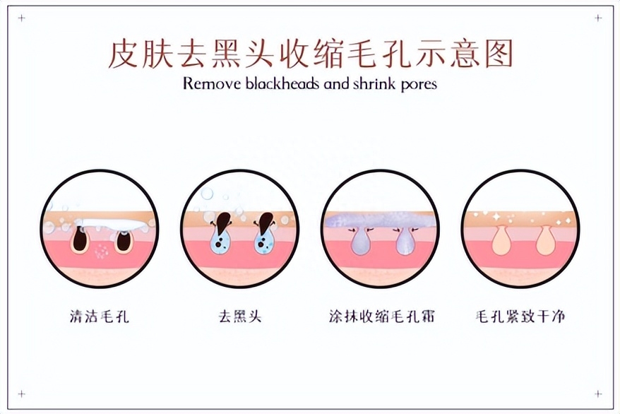 如何改善黑头，去黑头的方法简单实用