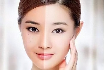 哪类人最容易长斑,女人容易长斑的原因